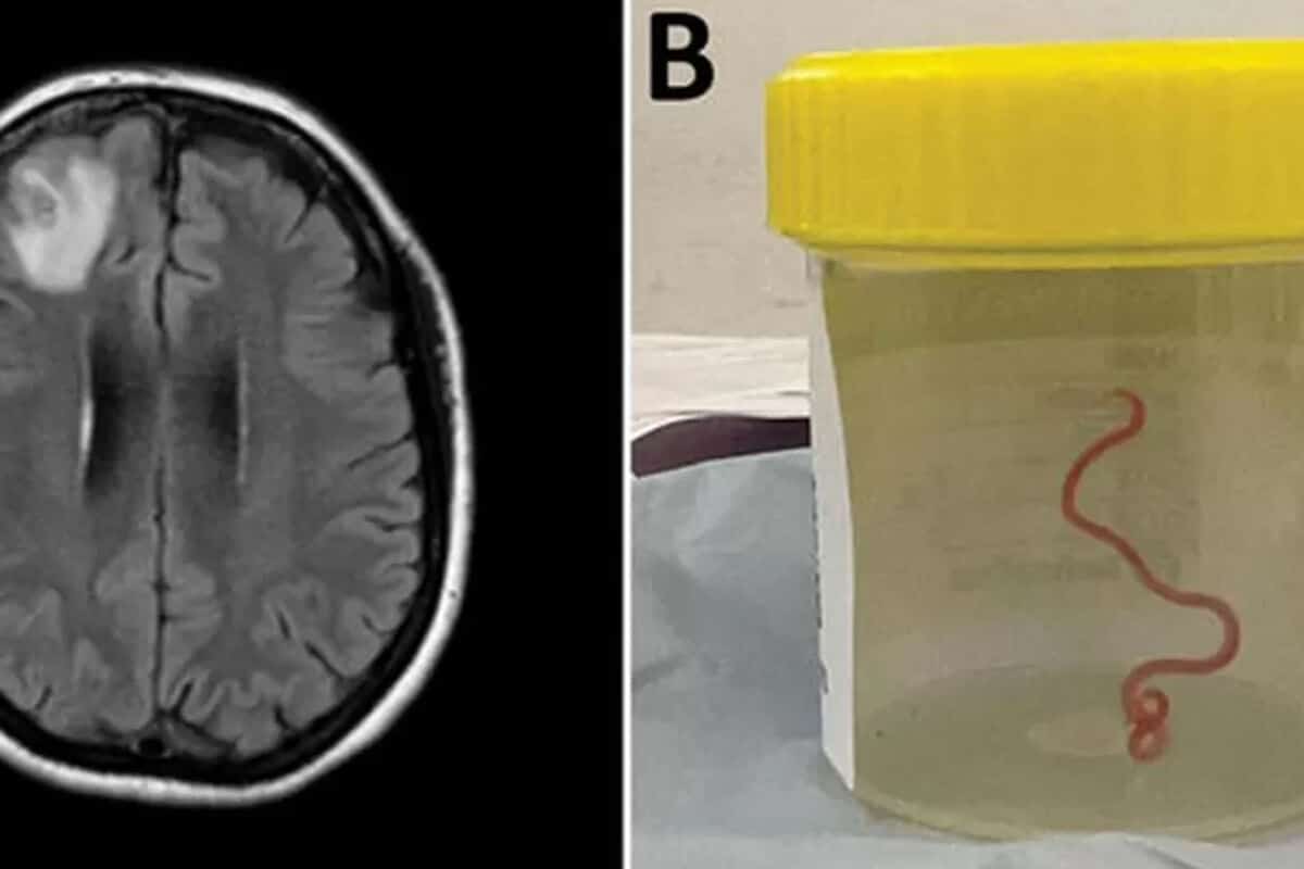 Encuentran Gusano Vivo de 8 cm en Cerebro de Mujer : La Impactante Verdad Revelada